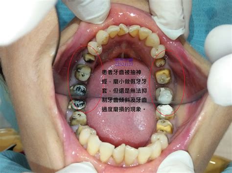 種牙齒
